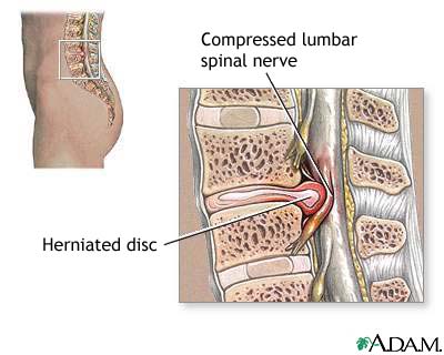 A disc bulge can occur anywhere along the spine.