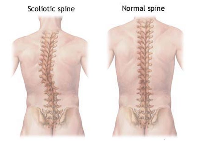 What Is Adolescent Idiopathic Scoliosis?