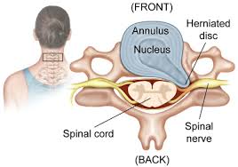 Cervical Disc Herniation: Signs & Treatment Options