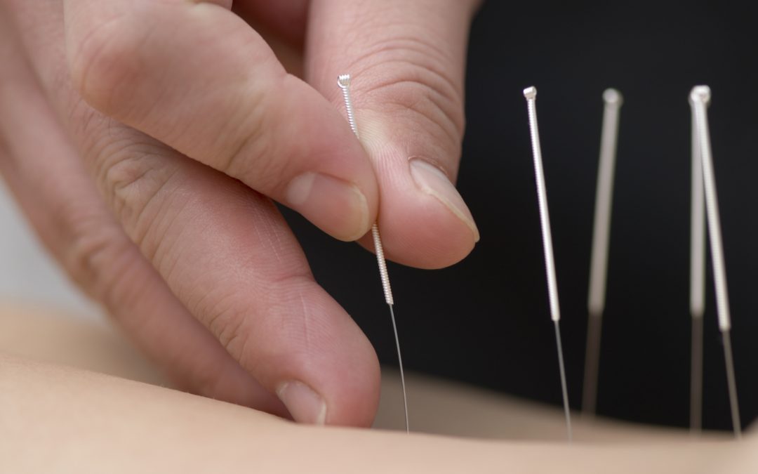 6 Reasons You Should Try Acupuncture