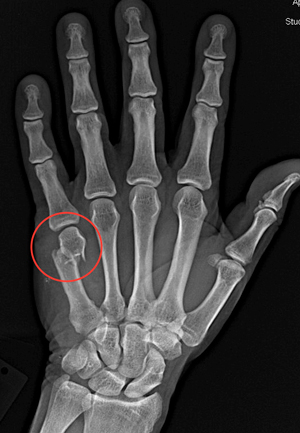 What Is A Boxers Fracture?