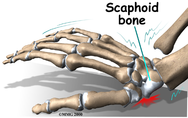 Have Your Suffered A Scaphoid Fracture?