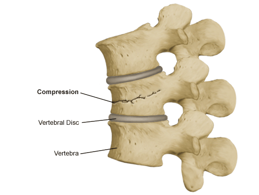 Are You At Risk Of Suffering A Vertebral Compression Fracture?