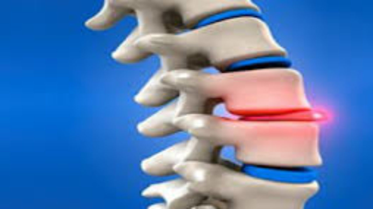 Slipped Disc | Causes, Symptoms & Treatment Options