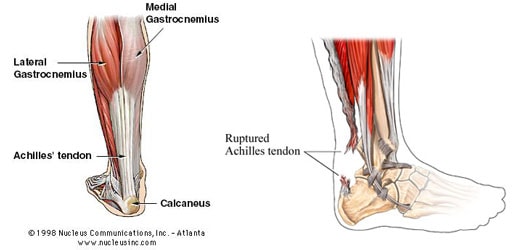Anatomy of the lower leg & Achilles tendon Achilles tendon rupture