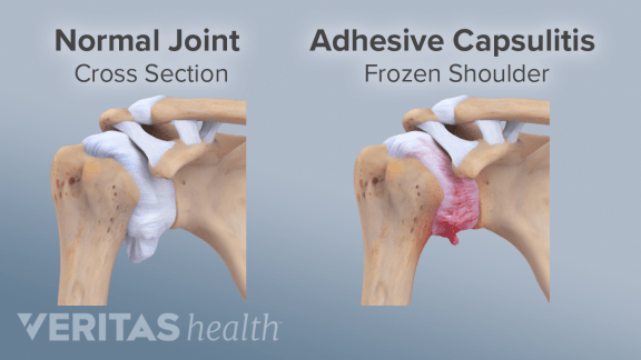 Adhesive Capsulitis (Frozen Shoulder) usually affects one shoulder at a time.
