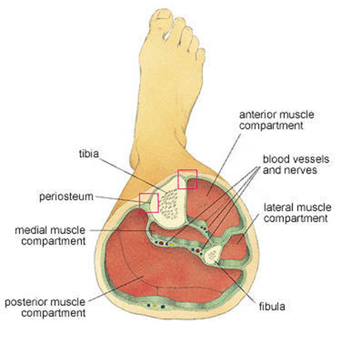 Compartment Syndrome of the lower leg.